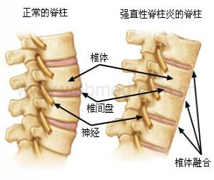 成都京研强直性脊柱炎医院
