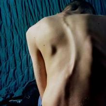 强直性脊柱炎症状