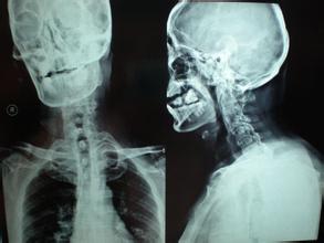 成都京研强直性脊柱炎医院