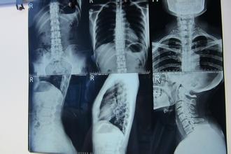 成都京研强直性脊柱炎研究院