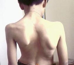 成都京研强直性脊柱炎研究院